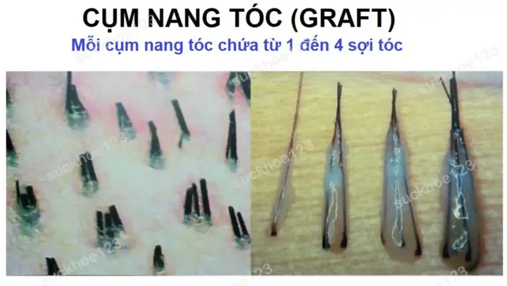 Đơn Vị Nang Tóc: Cấu Tạo, Số Lượng Và Vai Trò Trong Sự Phát Triển Của Tóc