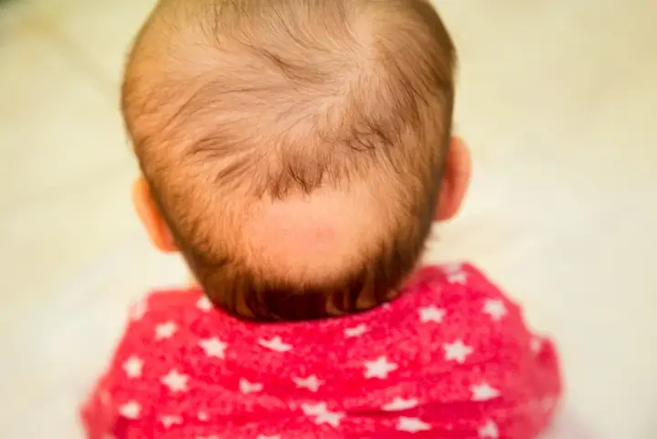 Bé Bị Rụng Tóc Vành Khăn: Phải Làm Sao? Nguyên Nhân & Cách Xử Lý Hiệu Quả