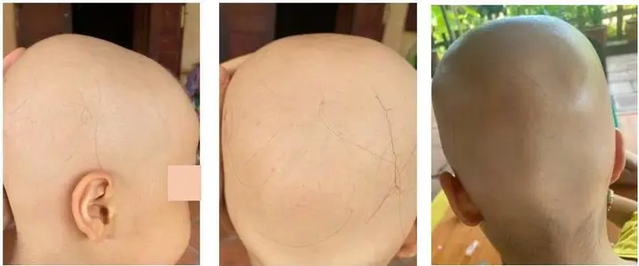 Rụng Tóc Toàn Thể (alopecia Totalis): Nguyên Nhân, Triệu Chứng Và Cách Điều Trị Hiệu Quả Rụng Tóc Toàn Thể (alopecia Totalis): Nguyên Nhân, Triệu Chứng Và Cách Điều Trị Hiệu Quả