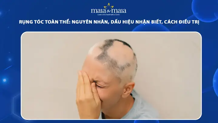 Rụng Tóc Toàn Thể (alopecia Totalis): Nguyên Nhân, Triệu Chứng Và Cách Điều Trị Hiệu Quả Rụng Tóc Toàn Thể (alopecia Totalis): Nguyên Nhân, Triệu Chứng Và Cách Điều Trị Hiệu Quả