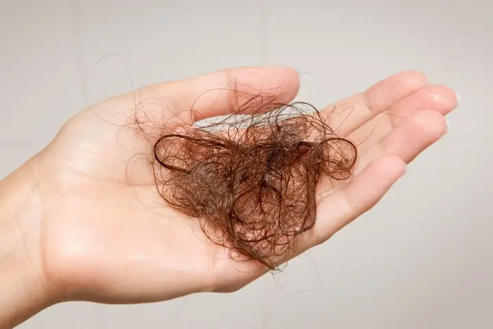 Rụng Tóc Toàn Thể (alopecia Totalis): Nguyên Nhân, Triệu Chứng Và Cách Điều Trị Hiệu Quả Rụng Tóc Toàn Thể (alopecia Totalis): Nguyên Nhân, Triệu Chứng Và Cách Điều Trị Hiệu Quả