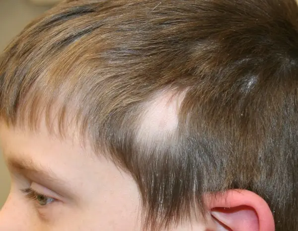 Alopecia Areata (rụng Tóc Từng Vùng): Nguyên Nhân, Triệu Chứng Và Cách Điều Trị Hiệu Quả Alopecia Areata (rụng Tóc Từng Vùng): Nguyên Nhân, Triệu Chứng Và Cách Điều Trị Hiệu Quả