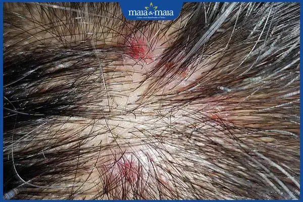 Bị Dị Ứng Thuốc Uốn Tóc: Dấu Hiệu, Cách Xử Lý Và Phòng Ngừa Hiệu Quả