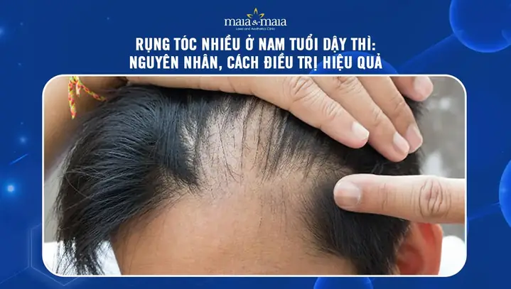 Rụng Tóc Nhiều Tuổi Dậy Thì: Nguyên Nhân, Cách Ngăn Ngừa Và Phục Hồi Hiệu Quả Cho Thanh Thiếu Niên