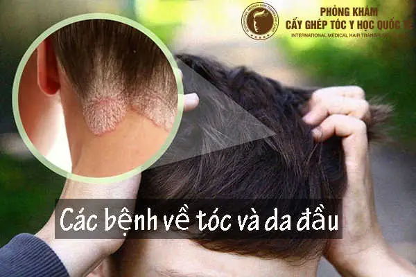 Khám Phá Các Bệnh Về Tóc Và Da Đầu: Nguyên Nhân, Dấu Hiệu & Giải Pháp Hiệu Quả Khám Phá Các Bệnh Về Tóc Và Da Đầu: Nguyên Nhân, Dấu Hiệu & Giải Pháp Hiệu Quả
