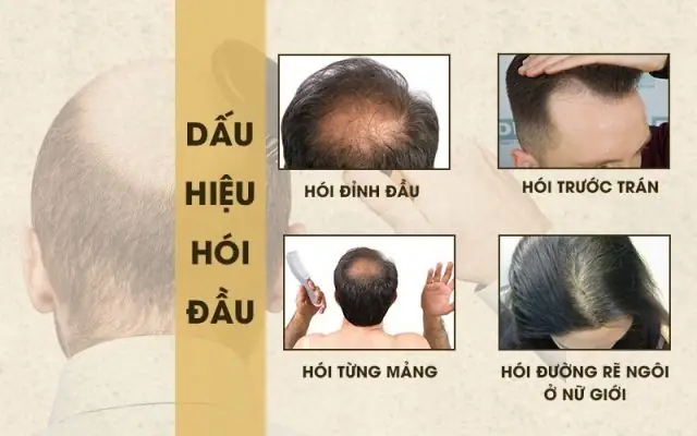 Cách Chữa Rụng Tóc Đỉnh Đầu: Nguyên Nhân & Giải Pháp Hiệu Quả Cho Nam & Nữ