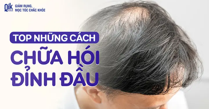 Cách Chữa Rụng Tóc Đỉnh Đầu: Nguyên Nhân & Giải Pháp Hiệu Quả Cho Nam & Nữ