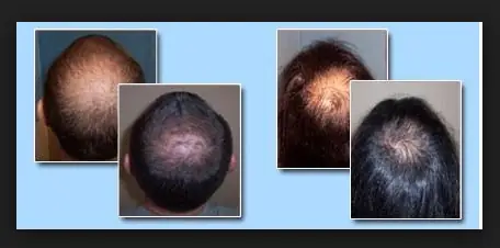 Cách Chữa Rụng Tóc Đỉnh Đầu: Nguyên Nhân & Giải Pháp Hiệu Quả Cho Nam & Nữ