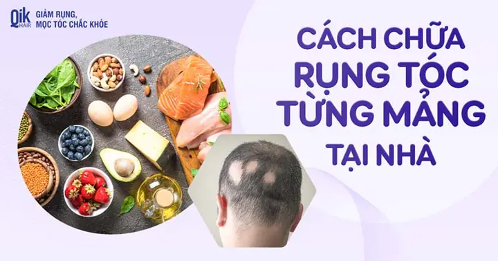Cách Chữa Rụng Tóc Từng Mảng Tại Nhà: Giải Pháp An Toàn & Hiệu Quả Tự Nhiên Cách Chữa Rụng Tóc Từng Mảng Tại Nhà: Giải Pháp An Toàn & Hiệu Quả Tự Nhiên