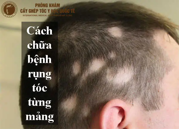 Cách Chữa Rụng Tóc Từng Mảng Tại Nhà: Giải Pháp An Toàn & Hiệu Quả Tự Nhiên Cách Chữa Rụng Tóc Từng Mảng Tại Nhà: Giải Pháp An Toàn & Hiệu Quả Tự Nhiên
