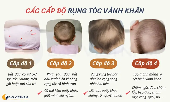 Cách Chữa Rụng Tóc Vành Khăn Ở Trẻ: Nguyên Nhân, Dấu Hiệu Và Giải Pháp Toàn Diện