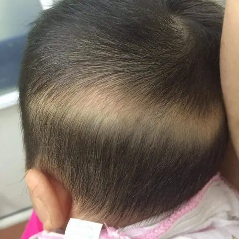 Cách Chữa Rụng Tóc Vành Khăn Ở Trẻ: Nguyên Nhân, Dấu Hiệu Và Giải Pháp Toàn Diện