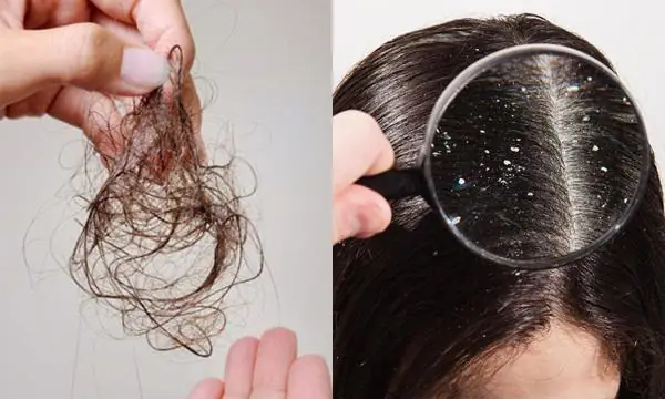 Cách Trị Gàu Hiệu Quả Dứt Điểm Tại Nhà Mà Không Cần Tốn Kém