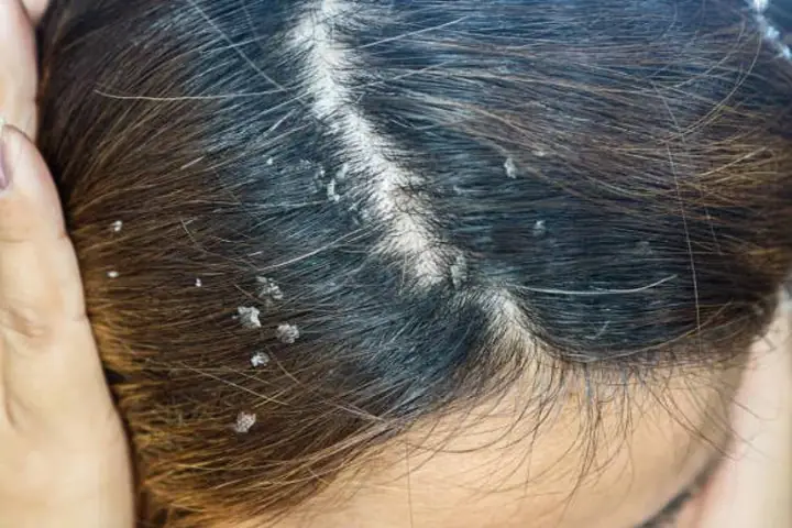 Cách Trị Gàu Hiệu Quả Dứt Điểm Tại Nhà Mà Không Cần Tốn Kém