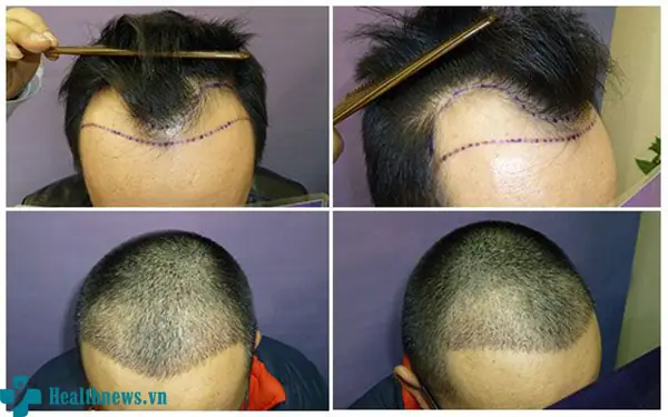Mọc Tóc Vùng Trán: Nguyên Nhân, Giải Pháp Tự Nhiên & Tác Động Chuyên Sâu Hiệu Quả Mọc Tóc Vùng Trán: Nguyên Nhân, Giải Pháp Tự Nhiên & Tác Động Chuyên Sâu Hiệu Quả