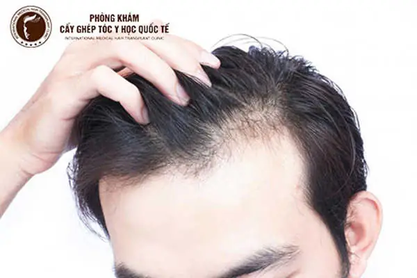 Mọc Tóc Vùng Trán: Nguyên Nhân, Giải Pháp Tự Nhiên & Tác Động Chuyên Sâu Hiệu Quả Mọc Tóc Vùng Trán: Nguyên Nhân, Giải Pháp Tự Nhiên & Tác Động Chuyên Sâu Hiệu Quả