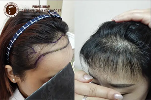 Bí Quyết Tóc Dài 10cm Trong 1 Tuần: Sự Thật Và Cách Thực Hiện Hiệu Quả