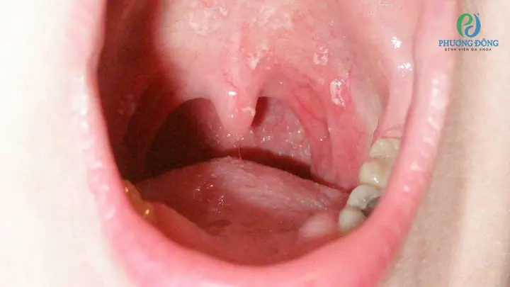 Cách Xử Lý Tóc Mắc Trong Cổ Họng: Hướng Dẫn An Toàn & Hiệu Quả Tại Nhà