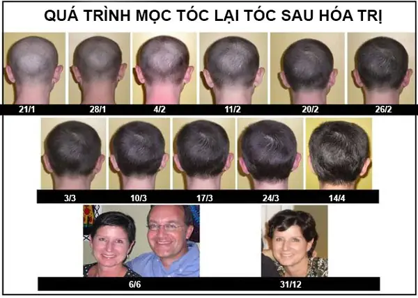 Tóc Mọc Nhanh Sau Hóa Trị: Bí Quyết Phục Hồi Toàn Diện Cho Bệnh Nhân Ung Thư