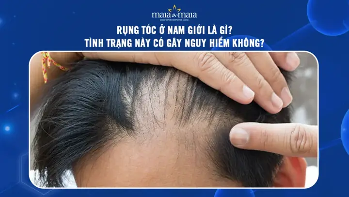Cách Ngăn Rụng Tóc Hiệu Quả Cho Nam Giới: Nguyên Nhân, Dấu Hiệu Và Giải Pháp Toàn Diện