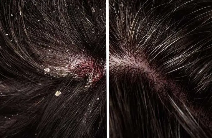 Cách Phân Biệt Gàu Và Nấm Da Đầu: Nhận Biết Triệu Chứng Và Lựa Chọn Điều Trị Hiệu Quả