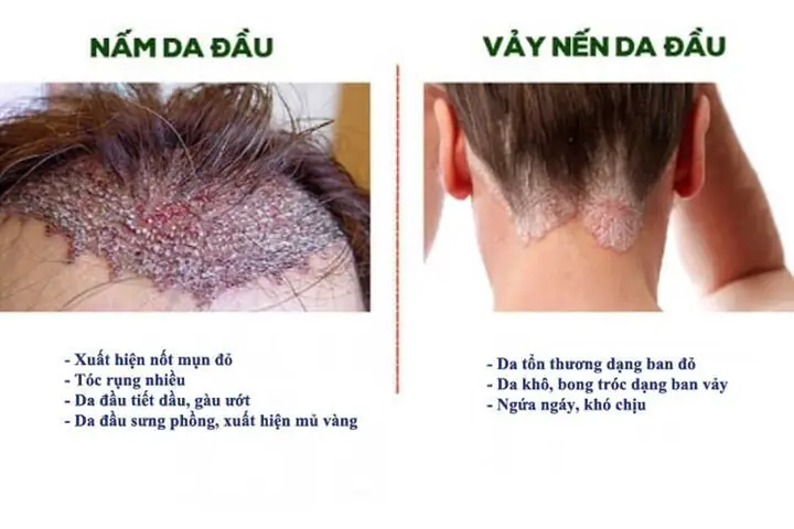 Cách Phân Biệt Gàu Và Nấm Da Đầu: Nhận Biết Triệu Chứng Và Lựa Chọn Điều Trị Hiệu Quả