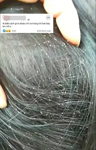 Cách Trị Chấy Rận Trên Tóc Hiệu Quả Tận Gốc Tại Nhà Cách Trị Chấy Rận Trên Tóc Hiệu Quả Tận Gốc Tại Nhà