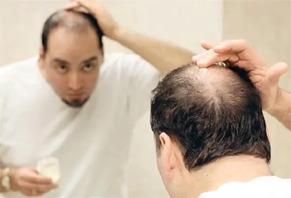 7+ Cách Trị Hói Đầu Ở Nam Giới Hiệu Quả, An Toàn | Nguyên Nhân & Giải Pháp Tối Ưu 7+ Cách Trị Hói Đầu Ở Nam Giới Hiệu Quả, An Toàn | Nguyên Nhân & Giải Pháp Tối Ưu