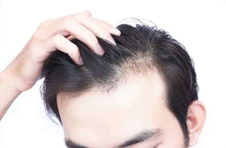 7+ Cách Trị Hói Đầu Ở Nam Giới Hiệu Quả, An Toàn | Nguyên Nhân & Giải Pháp Tối Ưu 7+ Cách Trị Hói Đầu Ở Nam Giới Hiệu Quả, An Toàn | Nguyên Nhân & Giải Pháp Tối Ưu