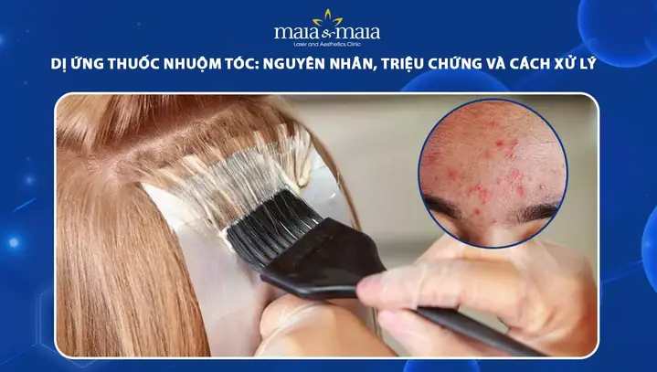 Cách Xử Lý Dị Ứng Thuốc Nhuộm Tóc An Toàn & Hiệu Quả Theo Khuyến Cáo Chuyên Gia