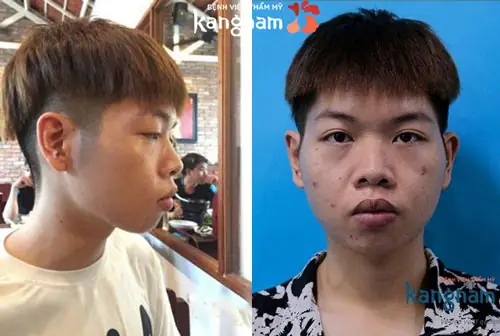 Cằm Lẹm Nên Để Tóc Gì? Top 15+ Kiểu Tóc Che Khuyết Điểm Hiệu Quả Cằm Lẹm Nên Để Tóc Gì? Top 15+ Kiểu Tóc Che Khuyết Điểm Hiệu Quả