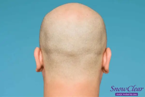 Cạo Đầu Tóc Có Mọc Nhiều Hơn Không? Sự Thật Về Niềm Tin Phổ Biến