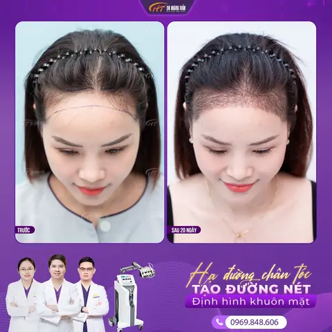Cấy Đường Chân Tóc Trán: Giải Pháp Toàn Diện Cho Trán Cao & Hói Tự Tin Cấy Đường Chân Tóc Trán: Giải Pháp Toàn Diện Cho Trán Cao & Hói Tự Tin