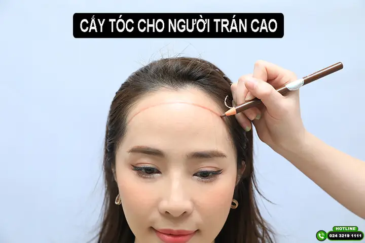 Cấy Đường Chân Tóc Trán: Giải Pháp Toàn Diện Cho Trán Cao & Hói Tự Tin Cấy Đường Chân Tóc Trán: Giải Pháp Toàn Diện Cho Trán Cao & Hói Tự Tin