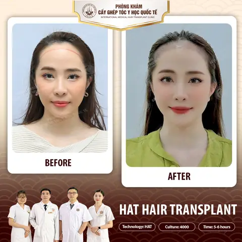 Cấy Đường Chân Tóc Trán: Giải Pháp Toàn Diện Cho Trán Cao & Hói Tự Tin Cấy Đường Chân Tóc Trán: Giải Pháp Toàn Diện Cho Trán Cao & Hói Tự Tin