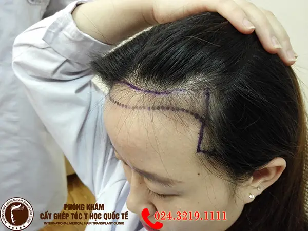 Cấy Đường Chân Tóc Trán: Giải Pháp Toàn Diện Cho Trán Cao & Hói Tự Tin Cấy Đường Chân Tóc Trán: Giải Pháp Toàn Diện Cho Trán Cao & Hói Tự Tin