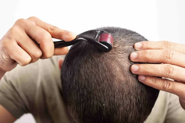 Lăn Kim Mọc Tóc: Hiệu Quả, Cách Thực Hiện Và Lưu Ý Quan Trọng Lăn Kim Mọc Tóc: Hiệu Quả, Cách Thực Hiện Và Lưu Ý Quan Trọng