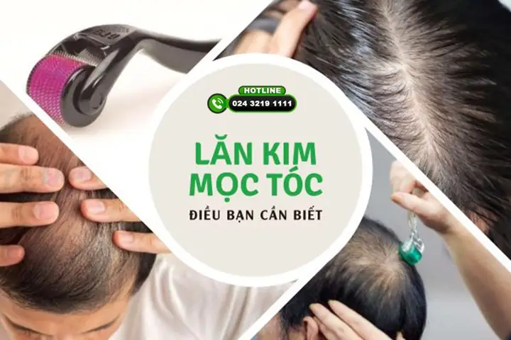 Lăn Kim Mọc Tóc: Hiệu Quả, Cách Thực Hiện Và Lưu Ý Quan Trọng Lăn Kim Mọc Tóc: Hiệu Quả, Cách Thực Hiện Và Lưu Ý Quan Trọng