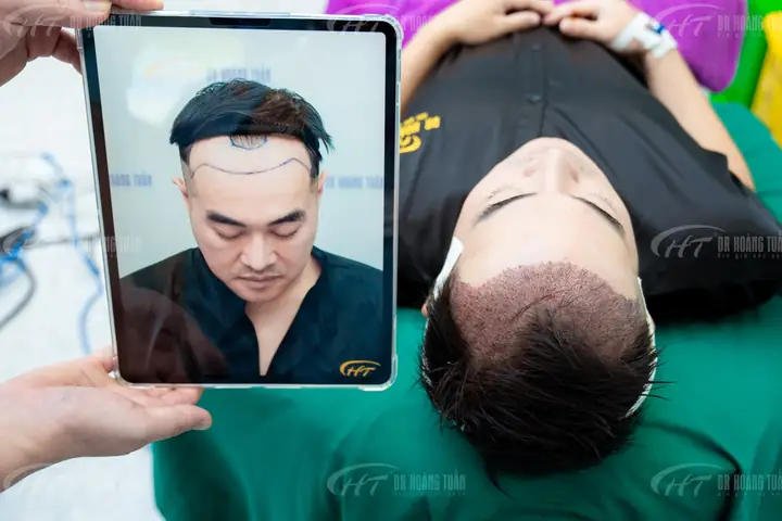 Cấy Tóc Cho Người Tóc Mỏng: Giải Pháp Hiệu Quả & Những Điều Cần Biết Cấy Tóc Cho Người Tóc Mỏng: Giải Pháp Hiệu Quả & Những Điều Cần Biết