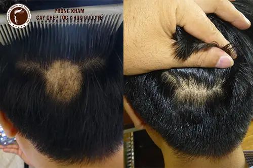Cấy Tóc Cho Vùng Sẹo Da Đầu: Khám Phá Giải Pháp Phục Hồi Tóc Tự Nhiên