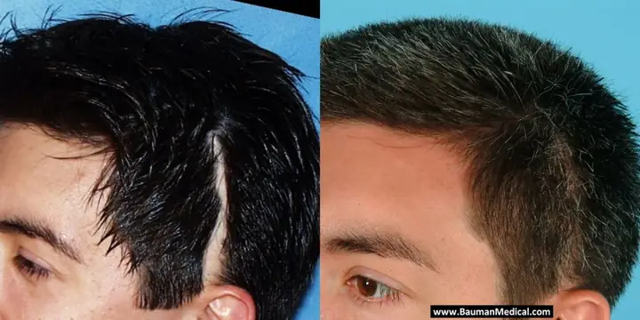 Cấy Tóc Cho Vùng Sẹo Da Đầu: Khám Phá Giải Pháp Phục Hồi Tóc Tự Nhiên