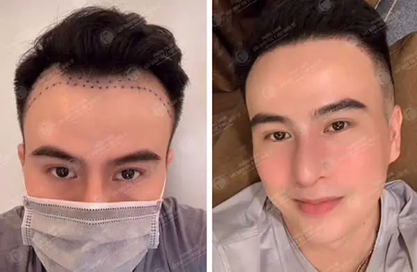 Cấy Tóc Có Hiệu Quả Không? Giải Đáp Tất Tần Tật A-z Cấy Tóc Có Hiệu Quả Không? Giải Đáp Tất Tần Tật A-z
