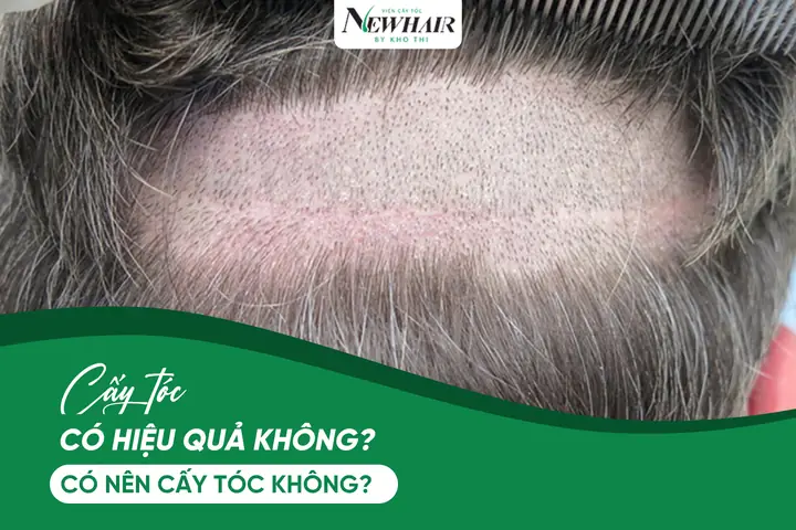 Cấy Tóc Có Hiệu Quả Không? Giải Đáp Tất Tần Tật A-z Cấy Tóc Có Hiệu Quả Không? Giải Đáp Tất Tần Tật A-z