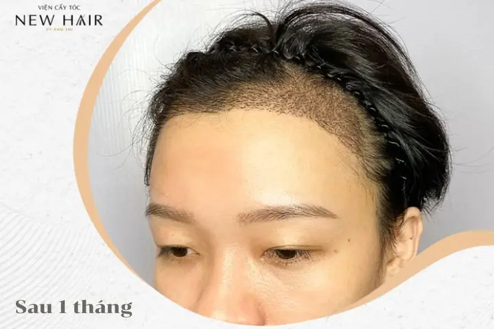 Cấy Tóc Hat Là Gì? Giải Đáp Toàn Diện Phương Pháp Hiện Đại Nhất Cấy Tóc Hat Là Gì? Giải Đáp Toàn Diện Phương Pháp Hiện Đại Nhất