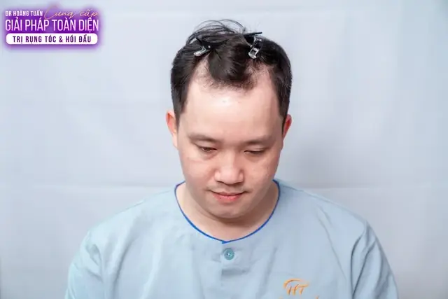 Cấy Tóc Tự Thân Ở Việt Nam: Chi Phí, Địa Chỉ Uy Tín & Những Điều Cần Biết Cập Nhật 2026