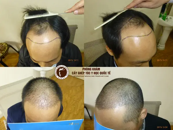 Cấy Tóc Tự Thân Ở Việt Nam: Chi Phí, Địa Chỉ Uy Tín & Những Điều Cần Biết Cập Nhật 2026