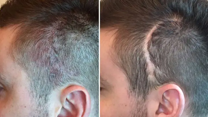 Cấy Tóc Trên Sẹo Giá Bao Nhiêu? Yếu Tố Ảnh Hưởng Và Bảng Giá Chi Tiết