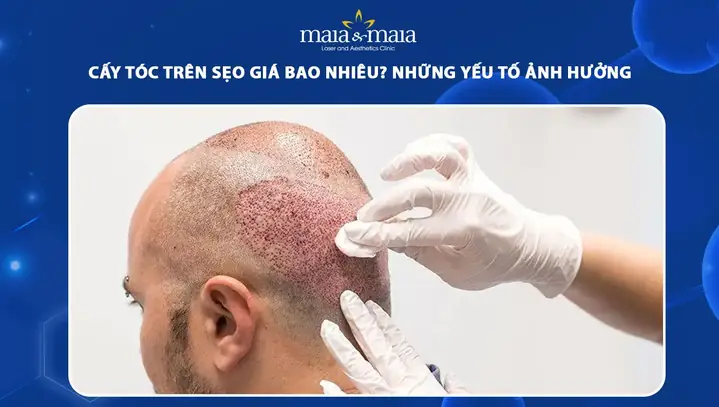 Cấy Tóc Trên Sẹo Giá Bao Nhiêu? Yếu Tố Ảnh Hưởng Và Bảng Giá Chi Tiết