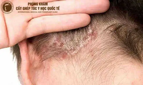 Chân Tóc Bị Teo Nhỏ: Nguyên Nhân Sâu Xa, Dấu Hiệu Nhận Biết Và Giải Pháp Phục Hồi Toàn Diện