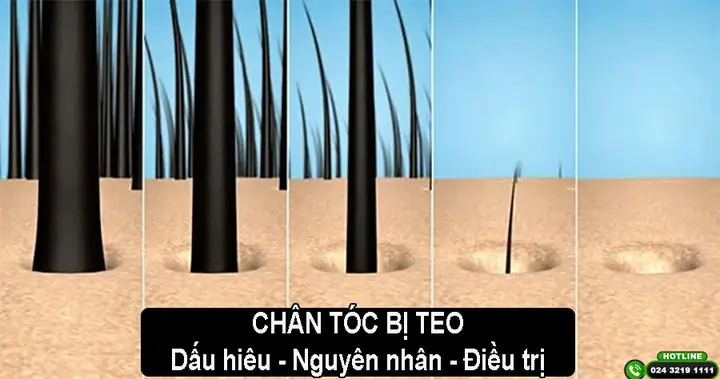 Chân Tóc Bị Teo Nhỏ: Nguyên Nhân Sâu Xa, Dấu Hiệu Nhận Biết Và Giải Pháp Phục Hồi Toàn Diện
